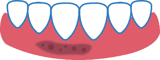 Treatment Of Oral Lesions